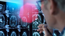 Vještačka inteligencija dijagnostifikuje demenciju za jedan dan